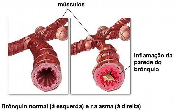 Comparação entre um brônquio normal (à esquerda) e um brônquio afectado por asma (à direita)